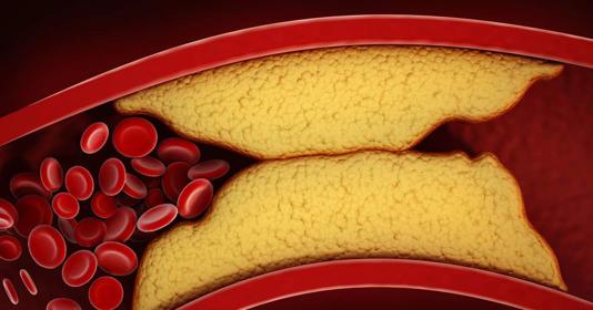 Novo comprimido reduz colesterol ruim em até 60%