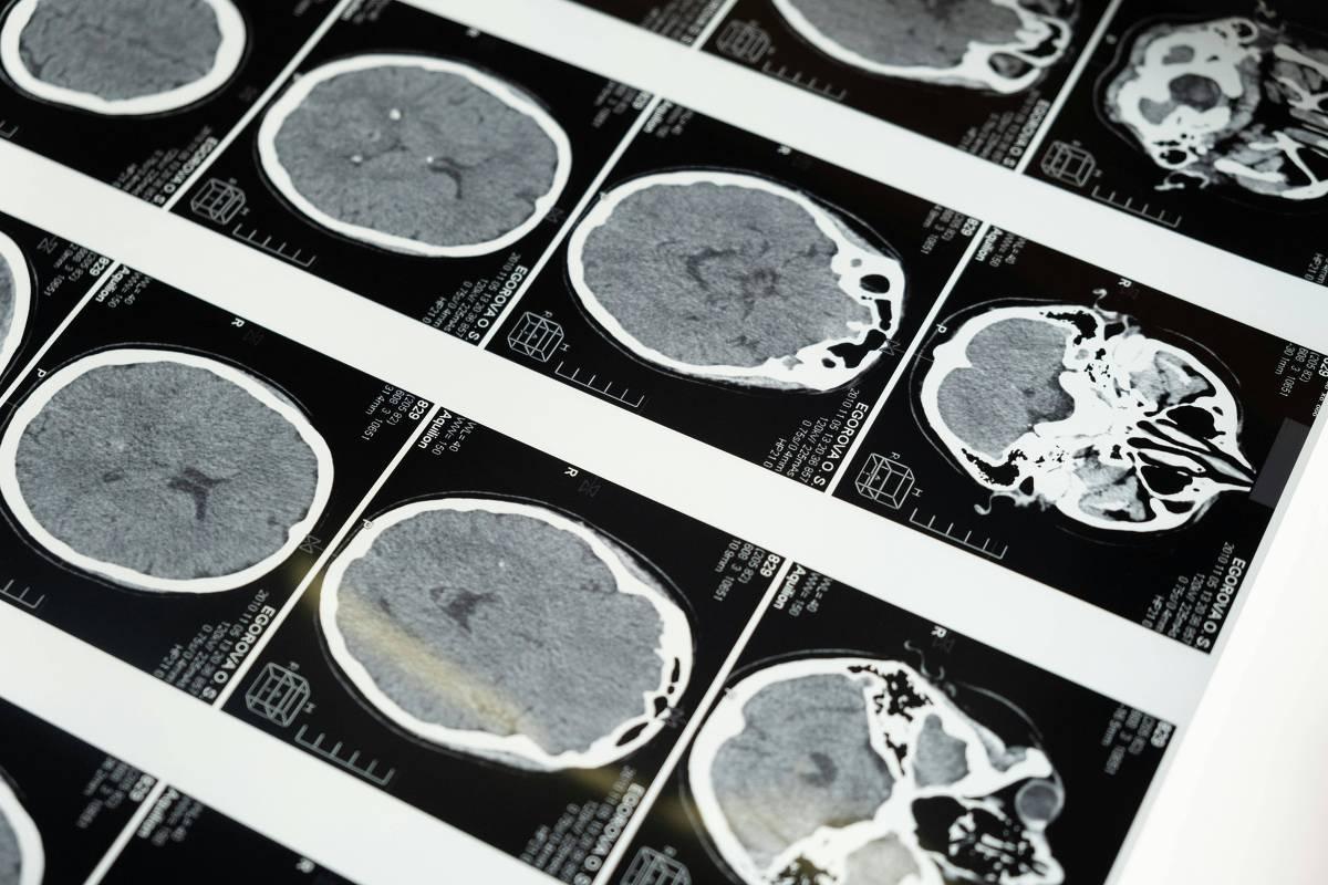 Anvisa amplia uso de remédios para lúpus e esclerose em crianças