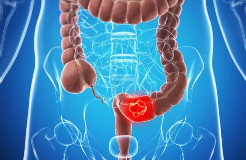 Câncer de intestino: 2 em cada 3 brasileiros não conhecem exame preventivo