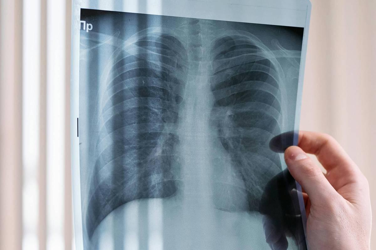 Pacientes com câncer de pulmão vivem menos no SUS, mostra estudo