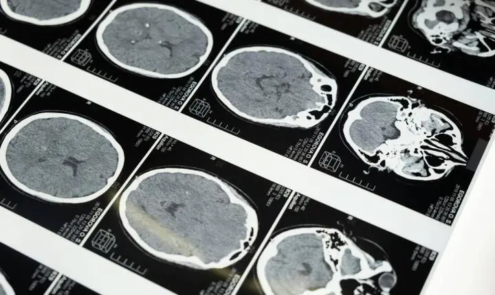 Anvisa amplia uso de remédios para lúpus e esclerose em crianças