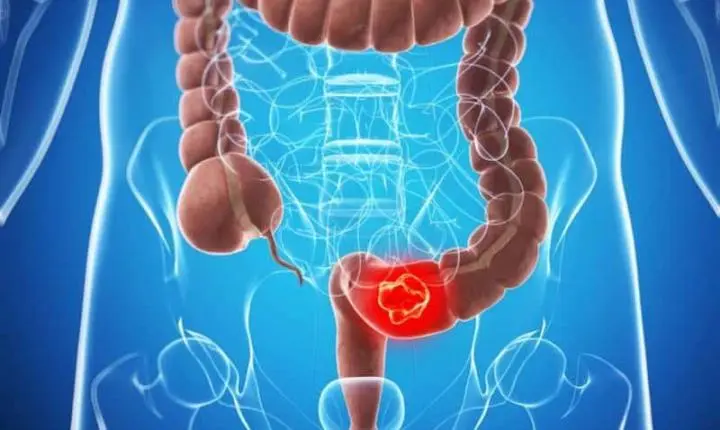 Câncer de intestino: 2 em cada 3 brasileiros não conhecem exame preventivo