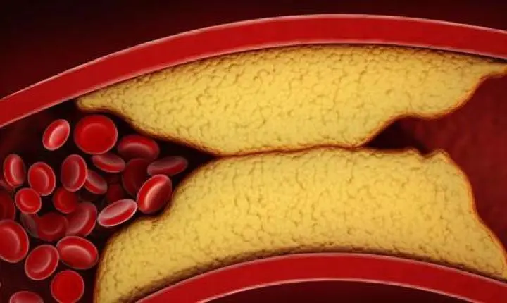 Novo comprimido reduz colesterol ruim em até 60%