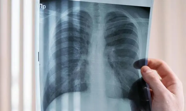 Pacientes com câncer de pulmão vivem menos no SUS, mostra estudo